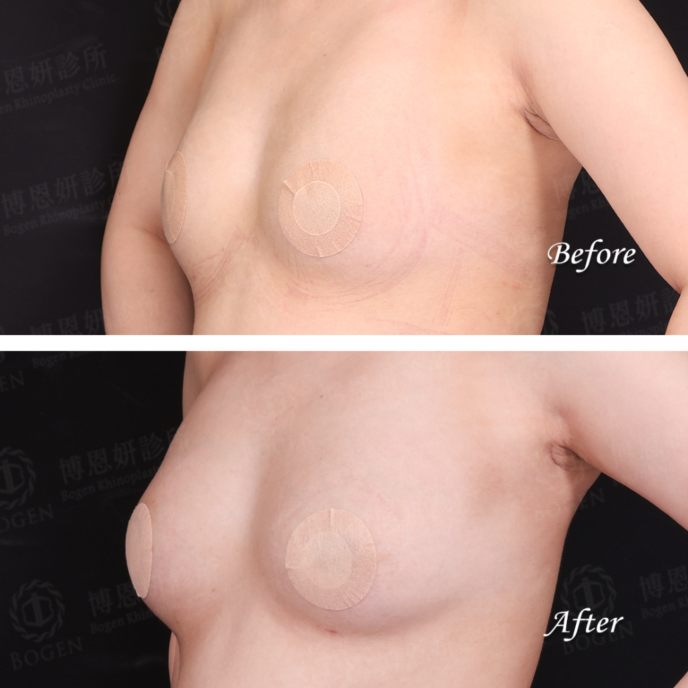 自體脂肪移植,自體脂肪移植胸部,自體脂肪移植隆乳,博恩妍